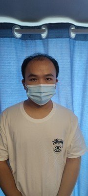 补发前正面效果:发际线高 补发前正面效果:发际线高
