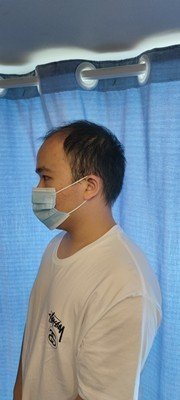 补发前侧面效果 补发前侧面效果
