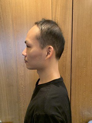 补发前头发稀疏 补发前头发稀疏