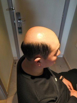 补发前秃顶 补发前秃顶