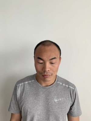 补发前头发稀疏M型脱发 补发前头发稀疏M型脱发