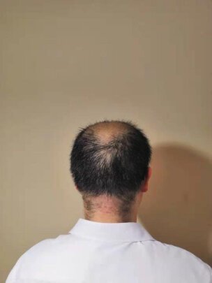 补发前效果 补发前效果