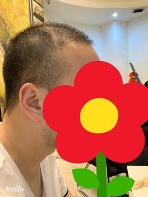 头发稀少 头发稀少