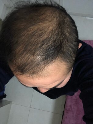 头发稀疏
