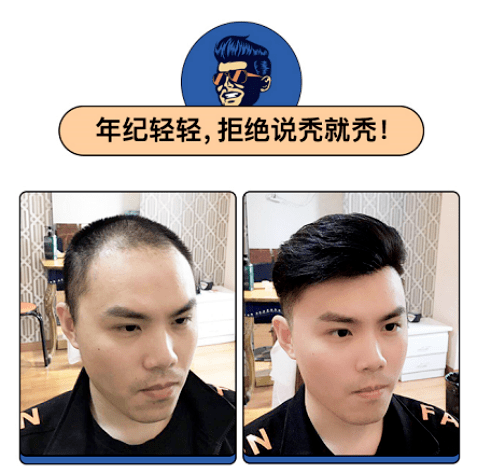 年纪轻轻,拒绝说秃就秃 年纪轻轻,拒绝说秃就秃
