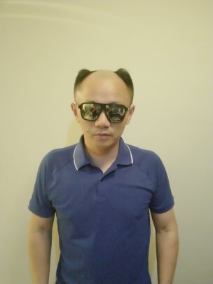 使用补发片前脱发效果 使用补发片前脱发效果