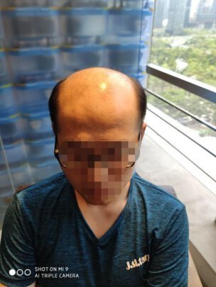 补发前秃顶,显老 补发前秃顶,显老