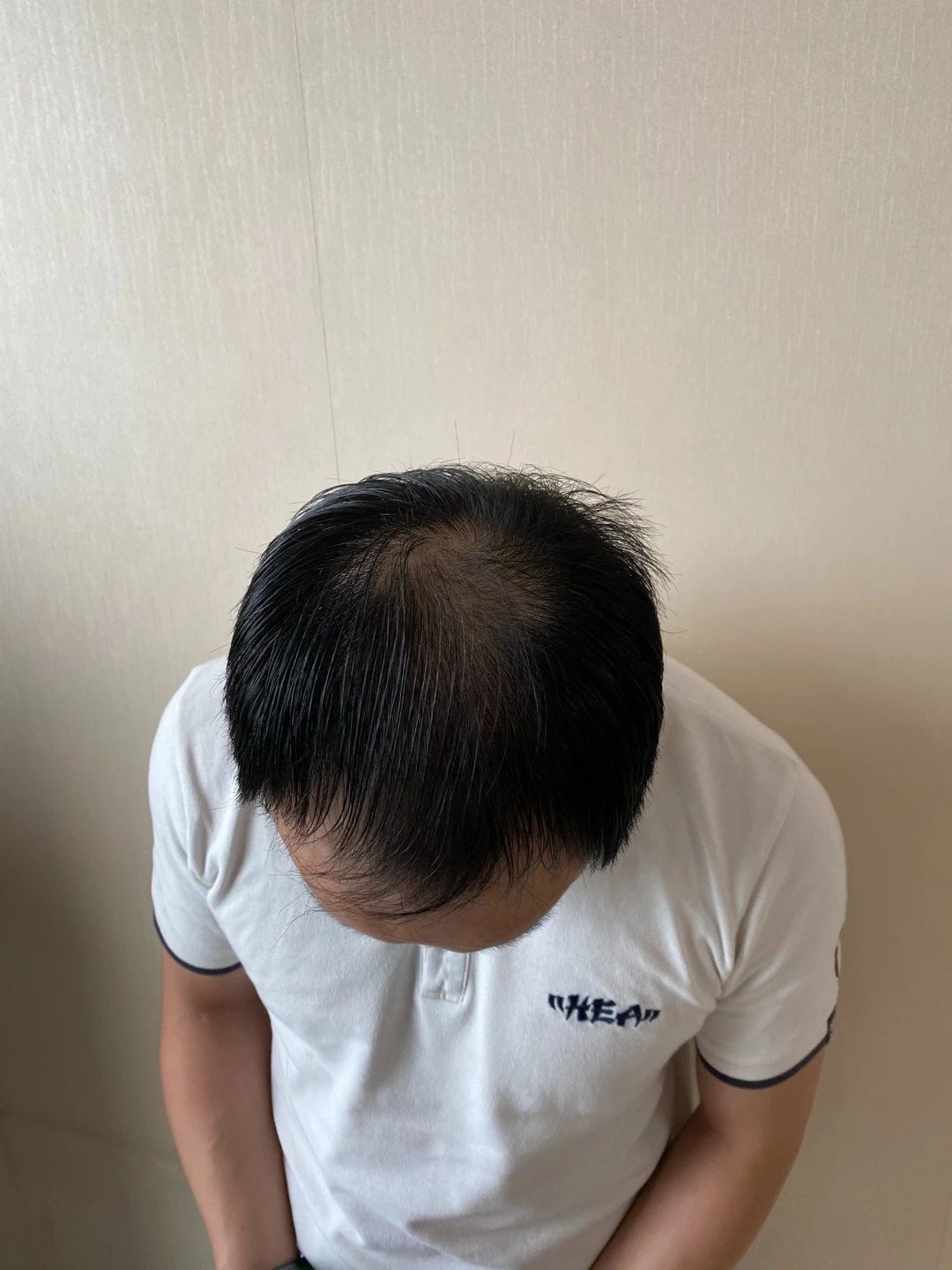 脱发补发前 脱发补发前