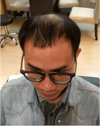 头顶秃出的头皮 再帅也只能算在大叔的行列 头顶秃出的头皮 再帅也只能算在大叔的行列