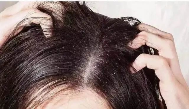 用指甲去挠头发 用指甲去挠头发