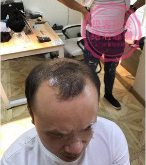 补发前M型脱发
