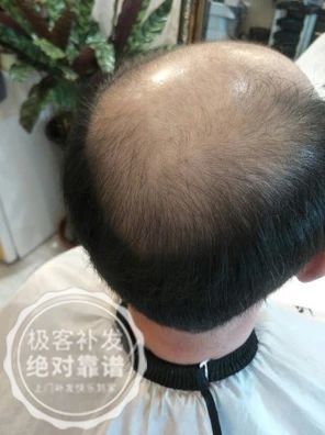 发际线高，头顶脱发严重