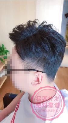 秃顶补发 秃顶补发
