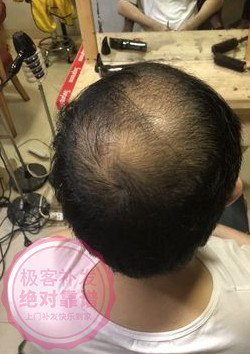 头顶头发稀少 头顶头发稀少