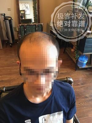 发友补发前头发稀少、秃顶 发友补发前头发稀少、秃顶