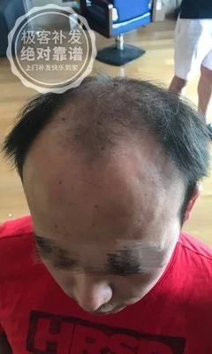 补发前接近秃顶 补发前接近秃顶
