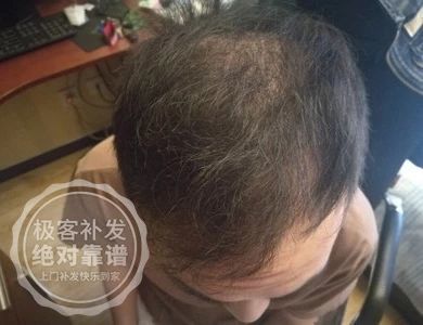 头顶稀疏,显老 头顶稀疏,显老