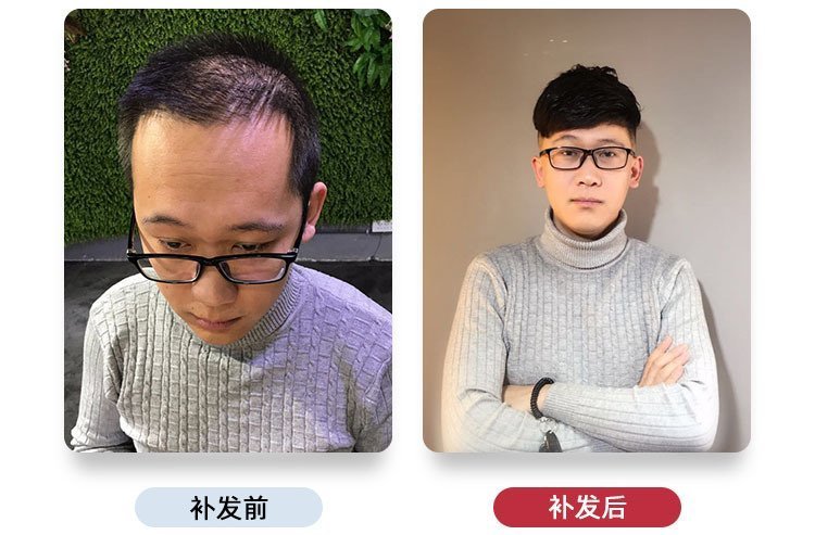 男士前额假发自然吗？