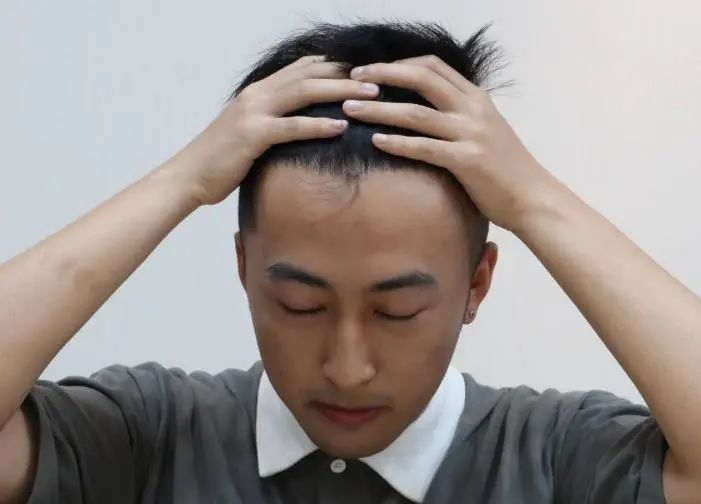 补发新人入门全知道——发际线补发篇