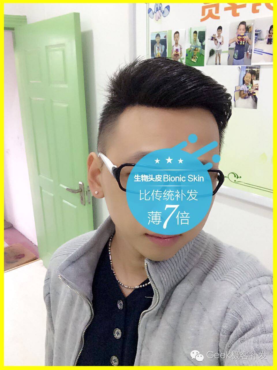 脱发补发后效果 脱发补发后效果