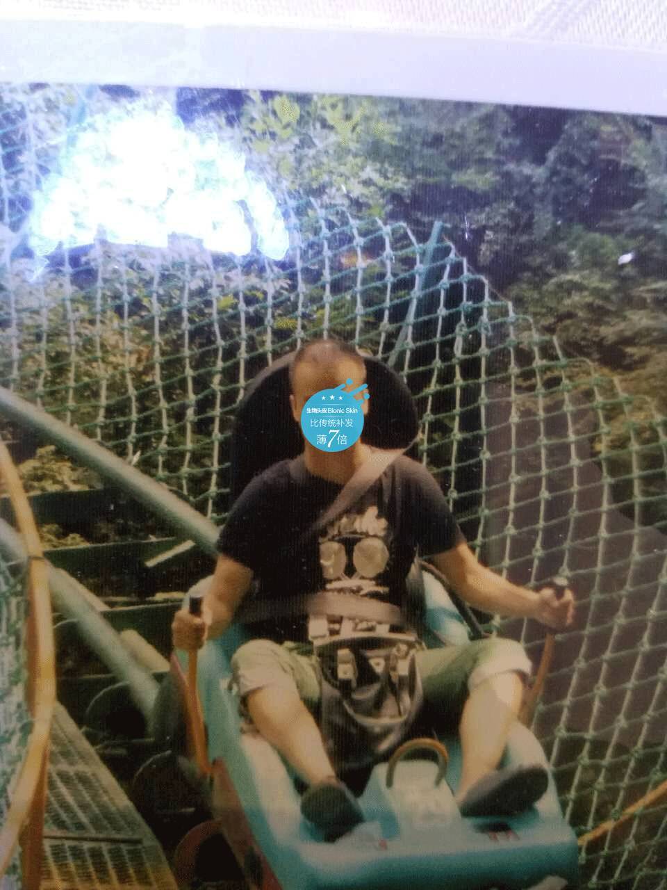 补发前M型脱发