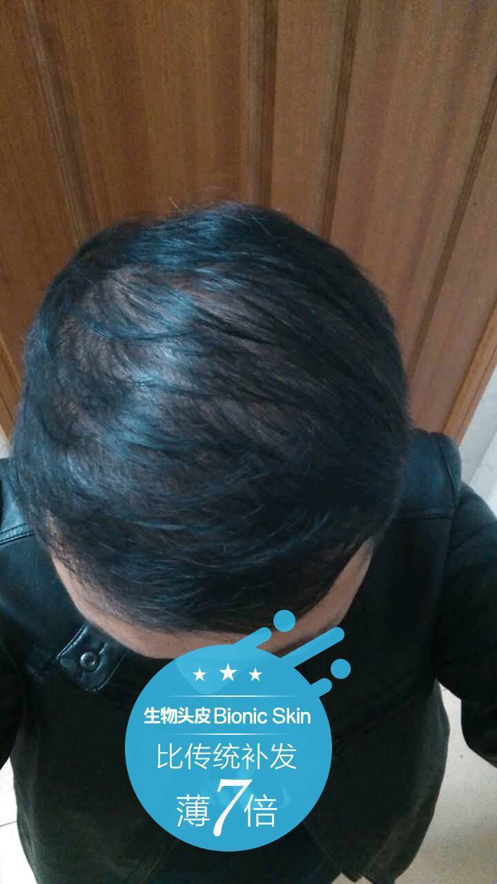 补发前头发稀少