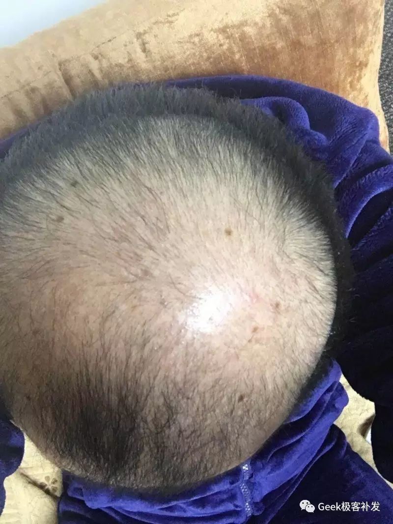 补发前头发稀少、秃顶 补发前头发稀少、秃顶