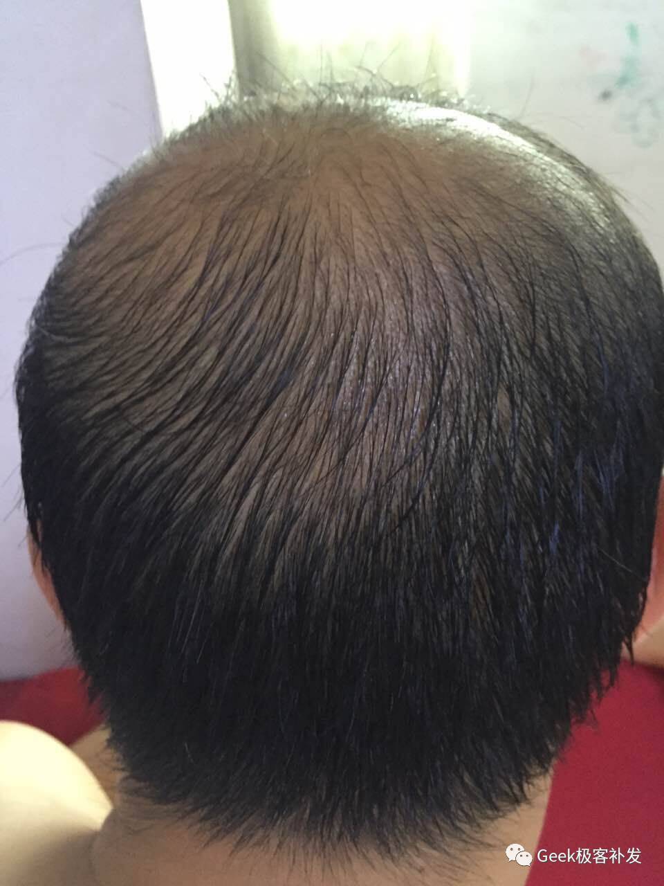 头发稀少