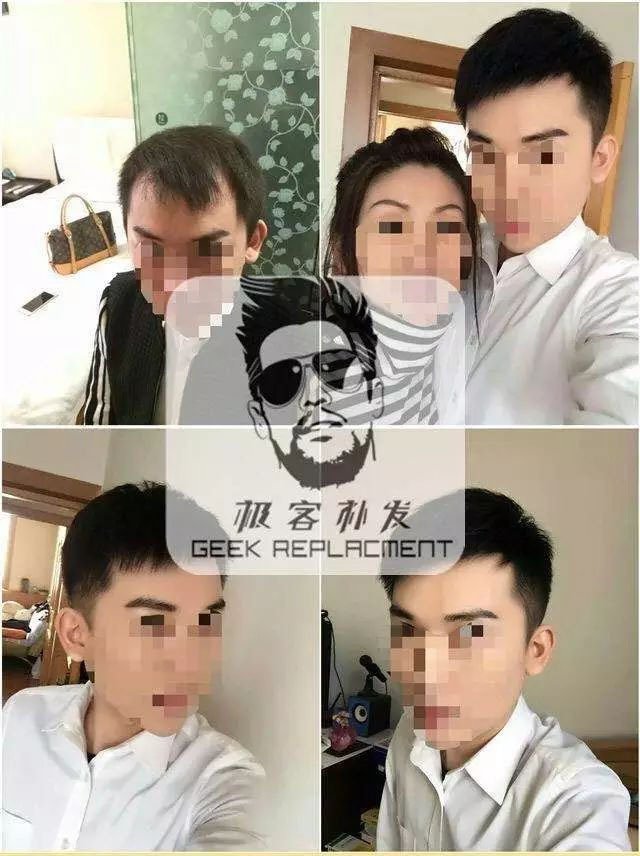 织发补发效果 织发补发效果