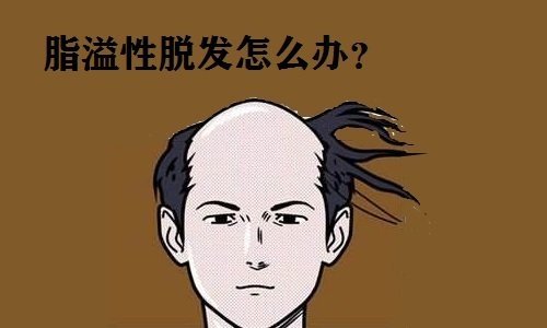 脂溢性脱发 脂溢性脱发