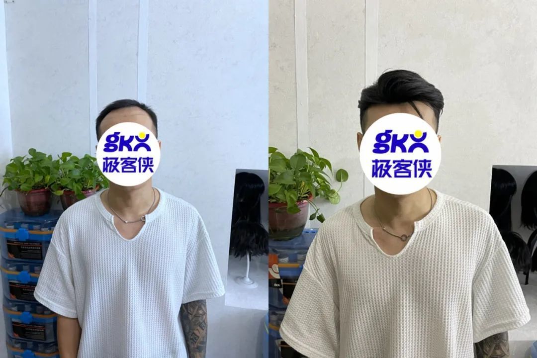 织发补发:男生发际线高的补救方法 织发补发:男生发际线高的补救方法