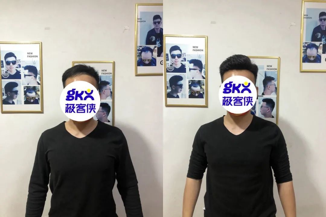 别让发际线影响你的帅气！