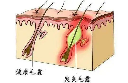 毛囊炎引起脱发？！我该怎么防治