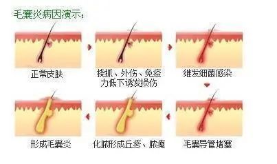 为什么会产生毛囊炎 为什么会产生毛囊炎