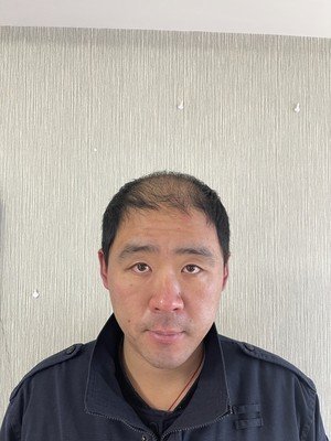 补发前头发秃顶