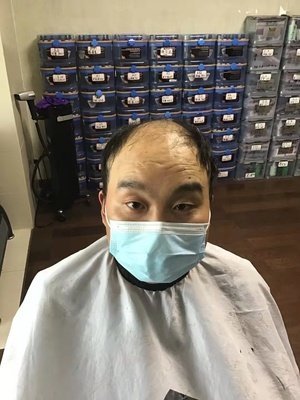 补发前脱发效果