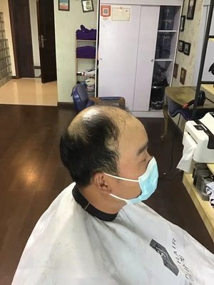 秃顶