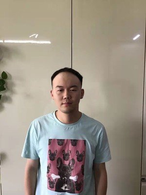 补发前发际线超高 补发前发际线超高