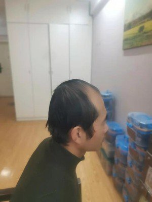 补发前侧面效果 补发前侧面效果