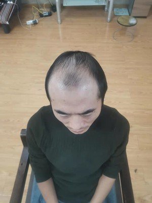 补发前秃顶效果 补发前秃顶效果