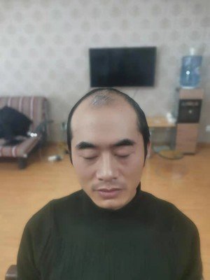 补发前秃顶效果 补发前秃顶效果
