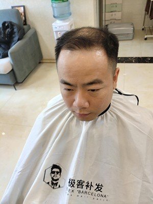 头顶头发稀少