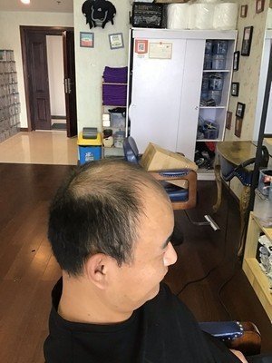 补发前侧面效果