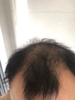 补发前M型脱发，头顶稀疏
