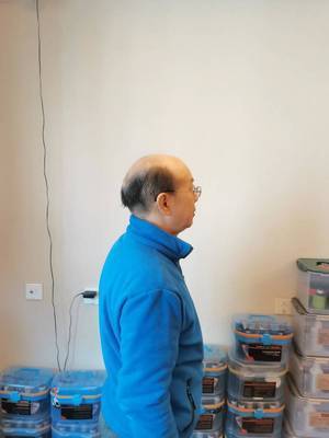 严重脱发秃顶——侧面 严重脱发秃顶——侧面