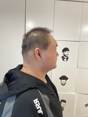 补发前发际线高、头发稀疏 补发前发际线高、头发稀疏