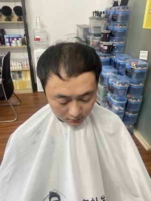 补发前发际线高,头发稀疏 补发前发际线高,头发稀疏