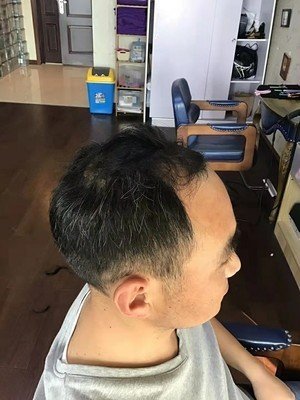 补发前侧面效果 补发前侧面效果