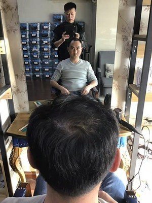 补发前正面效果:发际线超高 补发前正面效果:发际线超高