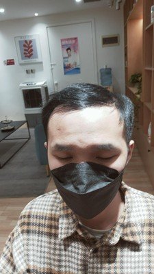 补发前正面发际线高 补发前正面发际线高